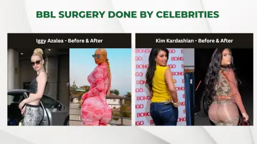 BBL Surgery Done by Celebrities